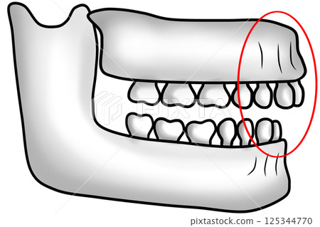 Abnormal jawbone structure with protruding upper jaw causing an overbite Abnormal jawbone structure with protruding upper jaw causing an overbite 125344770