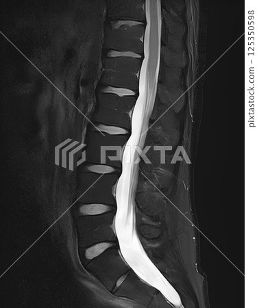 MRI of the lower back (fat suppressed image) 125350598