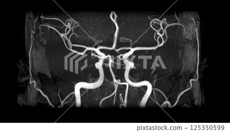 Brain MRI (MRA) 125350599