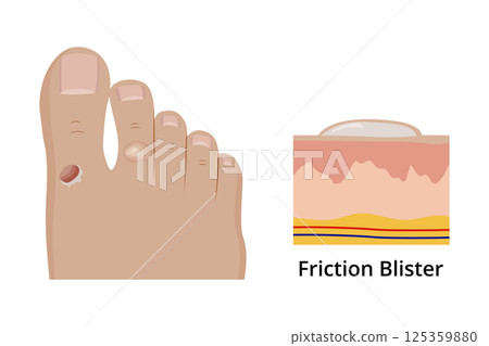 Friction blister forming on foot and its anatomical structure 125359880