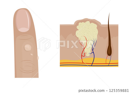 Common warts growing on finger and cross section of wart anatomy 125359881