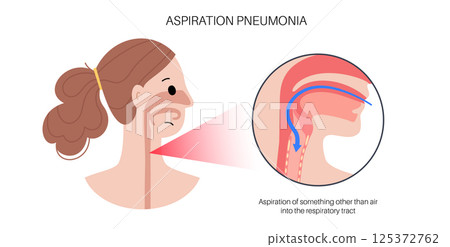 Aspiration pneumonia poster 125372762