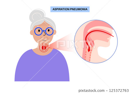 Aspiration pneumonia poster 125372763