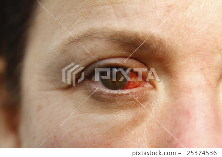 Close up of one annoyed red blood and health eye of female affected by conjunctivitis or after flu, cold or allergy. Concept of disease and treatment. Close up of one annoyed red blood and health eye of female affected by conjunctivitis or after flu, cold or allergy. Concept of disease and treatment. 125374536