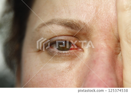 Close up of one annoyed red blood and health eye of female affected by conjunctivitis or after flu, cold or allergy. Concept of disease and treatment. 125374538