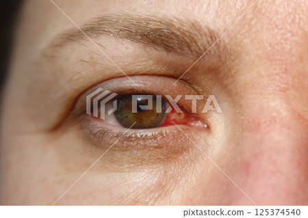 Close up of one annoyed red blood and health eye of female affected by conjunctivitis or after flu, cold or allergy. Concept of disease and treatment. 125374540