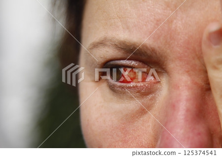 Close up of one annoyed red blood and health eye of female affected by conjunctivitis or after flu, cold or allergy. Concept of disease and treatment. 125374541