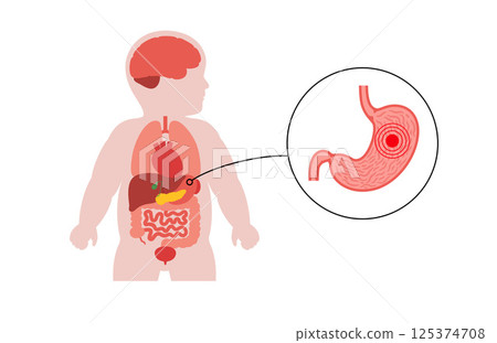 Stomach diseases in a child 125374708