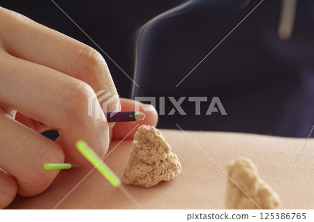 Moxibustion treatment at an acupuncture clinic 125386765