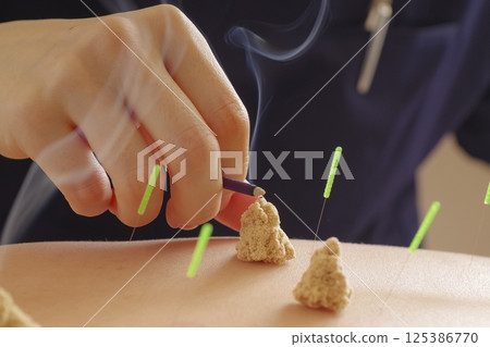 針灸診所的艾灸治療 125386770