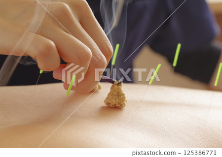 Moxibustion treatment at an acupuncture clinic 125386771