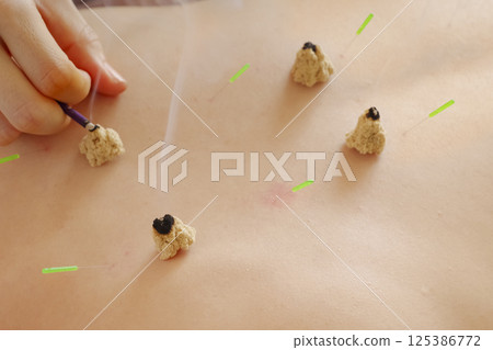 Moxibustion treatment at an acupuncture clinic 125386772