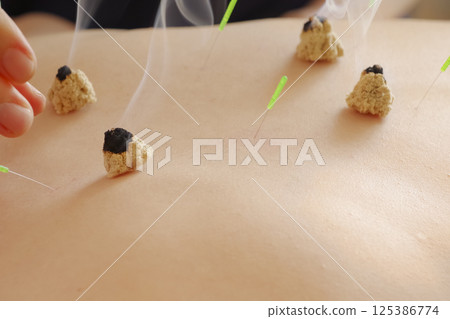 針灸診所的艾灸治療 125386774