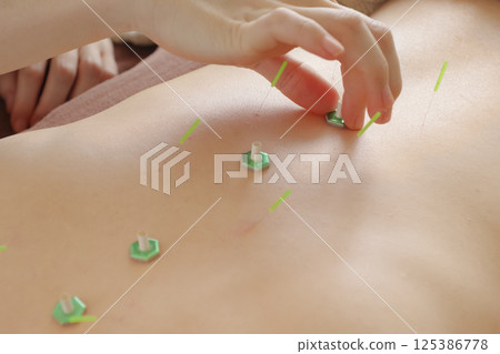 針灸診所的艾灸治療 125386778