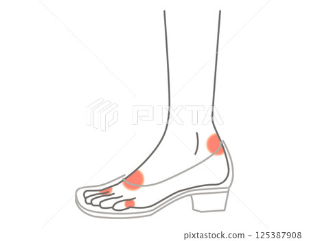 易起水泡的部位圖示 125387908