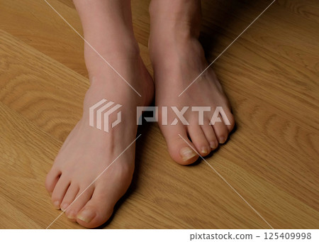 Close-up of a woman s foot with hallux valgus bunion and signs of toenail fungus. Her hand gently touches the deformed big toe, illustrating common foot problems and the need for medical care. 125409998