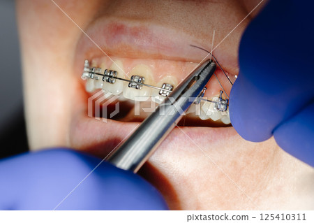 Dentist installing braces on patient's teeth using specialized tools 125410311
