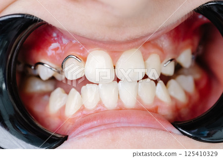 Close-up of dental appliance correcting teeth alignment during orthodontic treatment 125410329