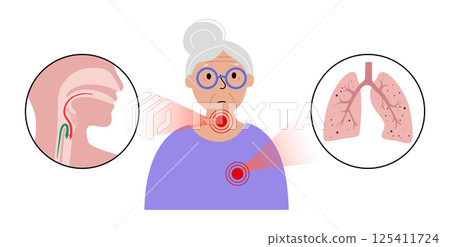 Aspiration pneumonia poster 125411724