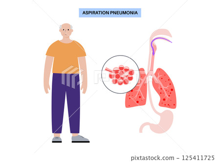 Aspiration pneumonia poster 125411725
