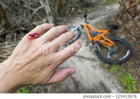 Biking accident. Mountain bike rider hand wounded from hitting a tree stump on forest trail 125413676