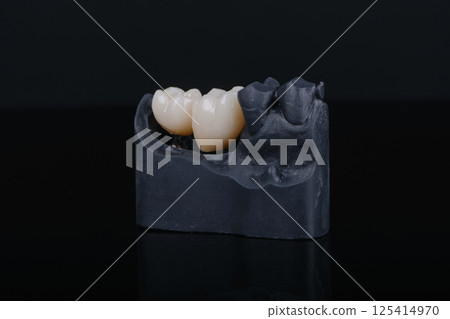 Two dental crowns made of zirconium on titanium abutments for fixation to implant Two dental crowns made of zirconium on titanium abutments for fixation to implant 125414970