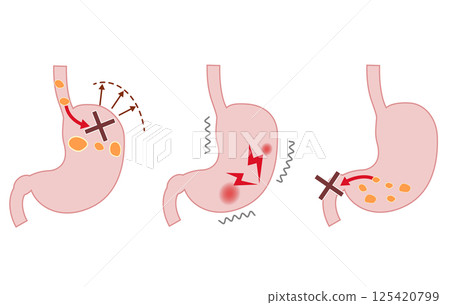Diagram of the symptoms and mechanism of functional dyspepsia (FD) Diagram of the symptoms and mechanism of functional dyspepsia (FD) 125420799