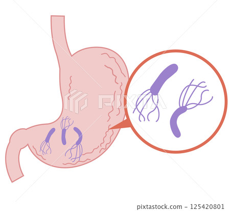 Stomach infected with Helicobacter pylori 125420801