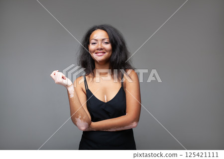 Confident female fashion model with vitiligo Confident female fashion model with vitiligo 125421111
