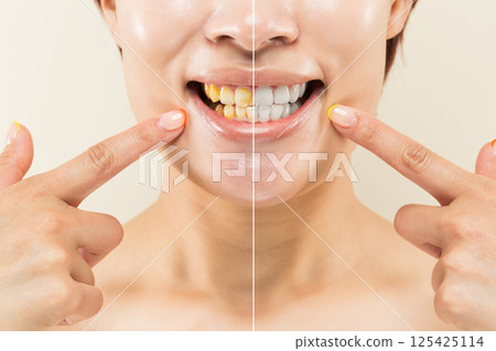 "Effects of whitening" A close-up relative comparison of yellowed teeth and white teeth. "Effects of whitening" A close-up relative comparison of yellowed teeth and white teeth. 125425114