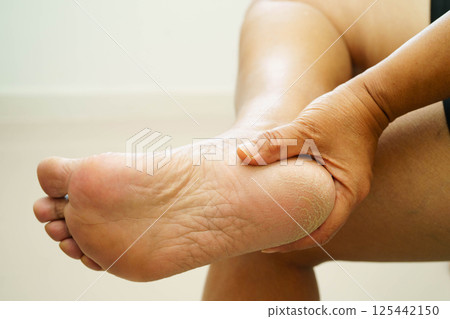 Asian woman check feet with crack and dry heel skin, Diabetic Foot. 125442150