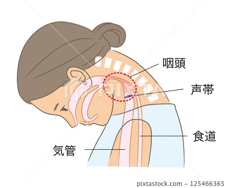 A woman with a narrowed pharynx due to a dropped neck 125466365