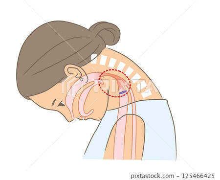 A woman with a narrowed pharynx due to a dropped neck 125466425