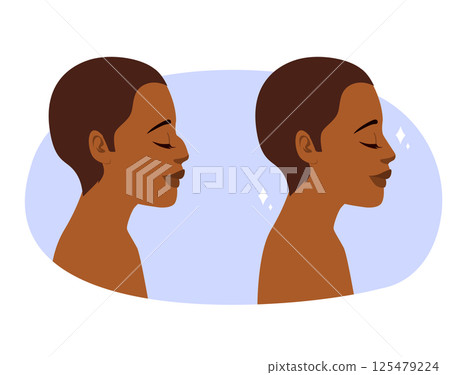 Rhinoplasty Before and After Surgery Woman Profile Cartoon Illustration Rhinoplasty Before and After Surgery Woman Profile Cartoon Illustration 125479224