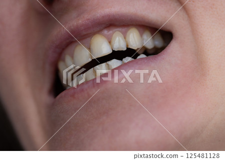 Woman showing teeth with dental calculus and plaque. Closeup. Dental care concept. 125481128