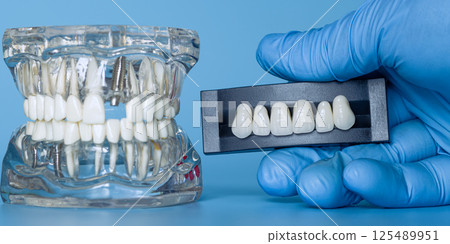 dental implant model alongside a gloved hand holding porcelain crowns 125489951