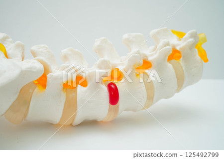 Spinal nerve and bone, Lumbar spine displaced herniated disc fragment, Model for treatment medical in the orthopedic department. Spinal nerve and bone, Lumbar spine displaced herniated disc fragment, Model for treatment medical in the orthopedic department. 125492799
