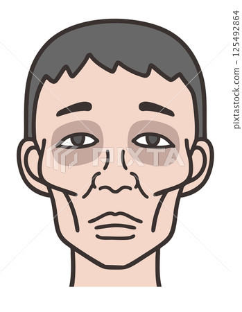 Hippocratic facies, an emaciated male face 125492864