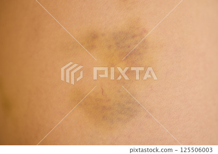 This is a Detailed Close Up Image of a Bruise Found on Human Skin Showing Various Aspects 125506003