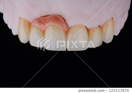 High-quality naturally dental single crowns made of zirconium for fixation to the frontal teeth of upper jaw. High-quality naturally dental single crowns made of zirconium for fixation to the frontal teeth of upper jaw. 125517674