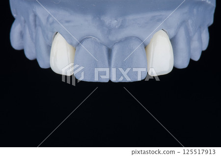 High-quality dental single crowns made of zirconium for fixation to the lateral upper jaw incisors 125517913