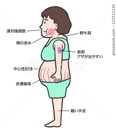 庫欣氏症候群的女性特徵:特徵性身體形態和症狀 庫欣氏症候群的女性特徵:特徵性身體形態和症狀 125522230