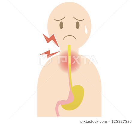People with gastroesophageal reflux disease who experience a sore throat due to stomach acid reflux 125527583