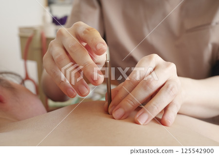 一名婦女在針灸診所接受背部針灸治療 一名婦女在針灸診所接受背部針灸治療 125542900