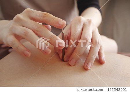 一名婦女在針灸診所接受背部針灸治療 125542901