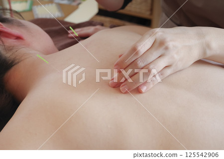 Woman receiving acupuncture treatment on her back at an acupuncture clinic Woman receiving acupuncture treatment on her back at an acupuncture clinic 125542906