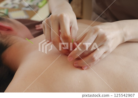 一名婦女在針灸診所接受背部針灸治療 125542907