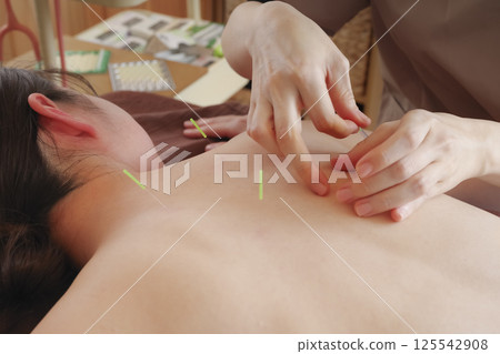 Woman receiving acupuncture treatment on her back at an acupuncture clinic 125542908