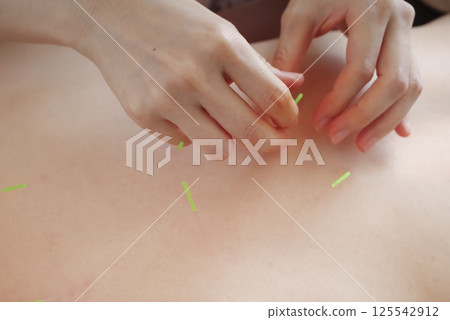 一名婦女在針灸診所接受背部針灸治療 125542912