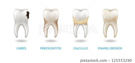 Illustrations of Common Dental Problems 125553290
